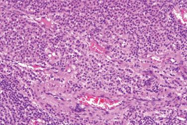 Fig. 7, Classical (solid) glomus tumor.