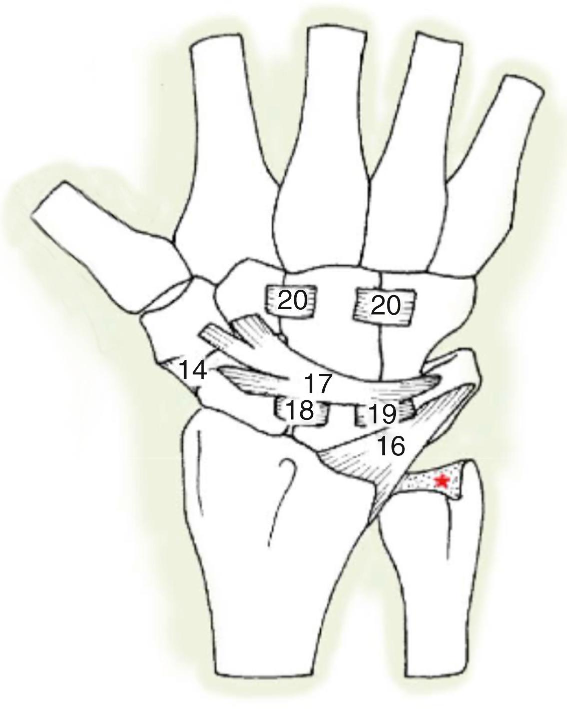 Fig. 72.2, Dorsal ligaments: radial triquetrum, also referred to as dorsal radiocarpal (16) ; triquetrum-scaphoid-trapeziotrapezoid, also known as the dorsal intercarpal ligament (17) ; dorsal scapholunate (18) ; dorsal lunate triquetrum (19) ; and dorsal transverse interosseous ligaments of the distal row (20) . (Asterisk) Triangular fibrocartilage.