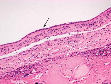 Figure 18.2, Acute chorioamnionitis, in this case maternal stage 2 grade 2. Black arrow points to the amniotic epithelium and white arrow to the chorionic epithelium.