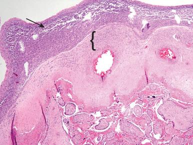 Figure 18.3, Acute chorioamnionitis on the chorionic plate ( arrow points to neutrophils in chorionic plate mesoderm). This is maternal stage 3 grade 2, fetal stage 1 (bracket) grade 2.