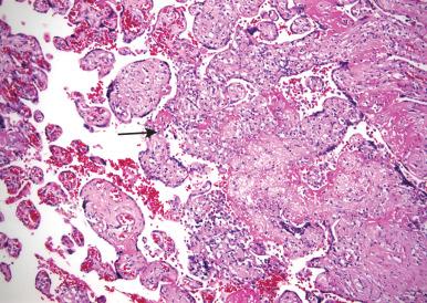 Figure 18.4, Chronic villitis.