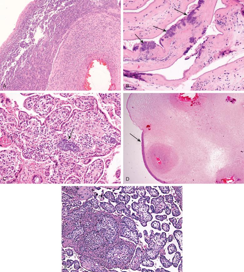 Figure 18.5, Group B streptococcal (GBS) placentitis.