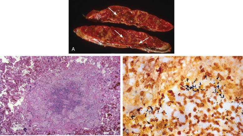 Figure 18.7, Listerial placentitis.