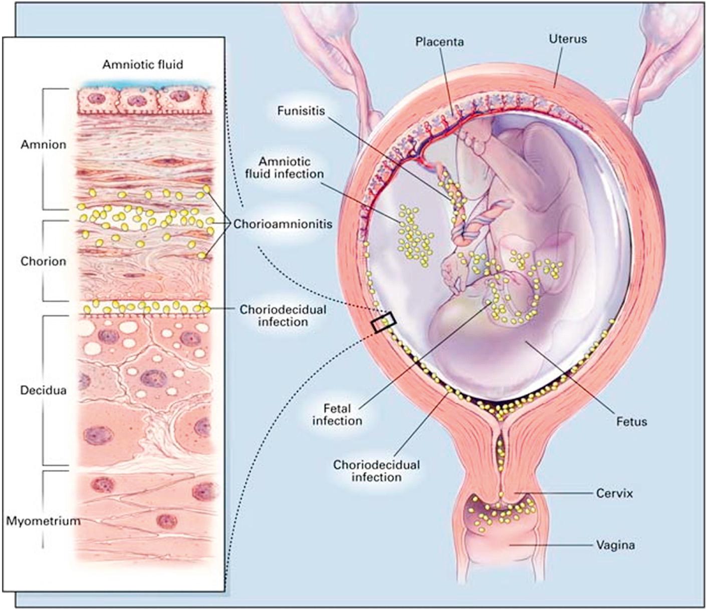 Fig. 25.1, Potential sites of bacterial infection within the uterus.