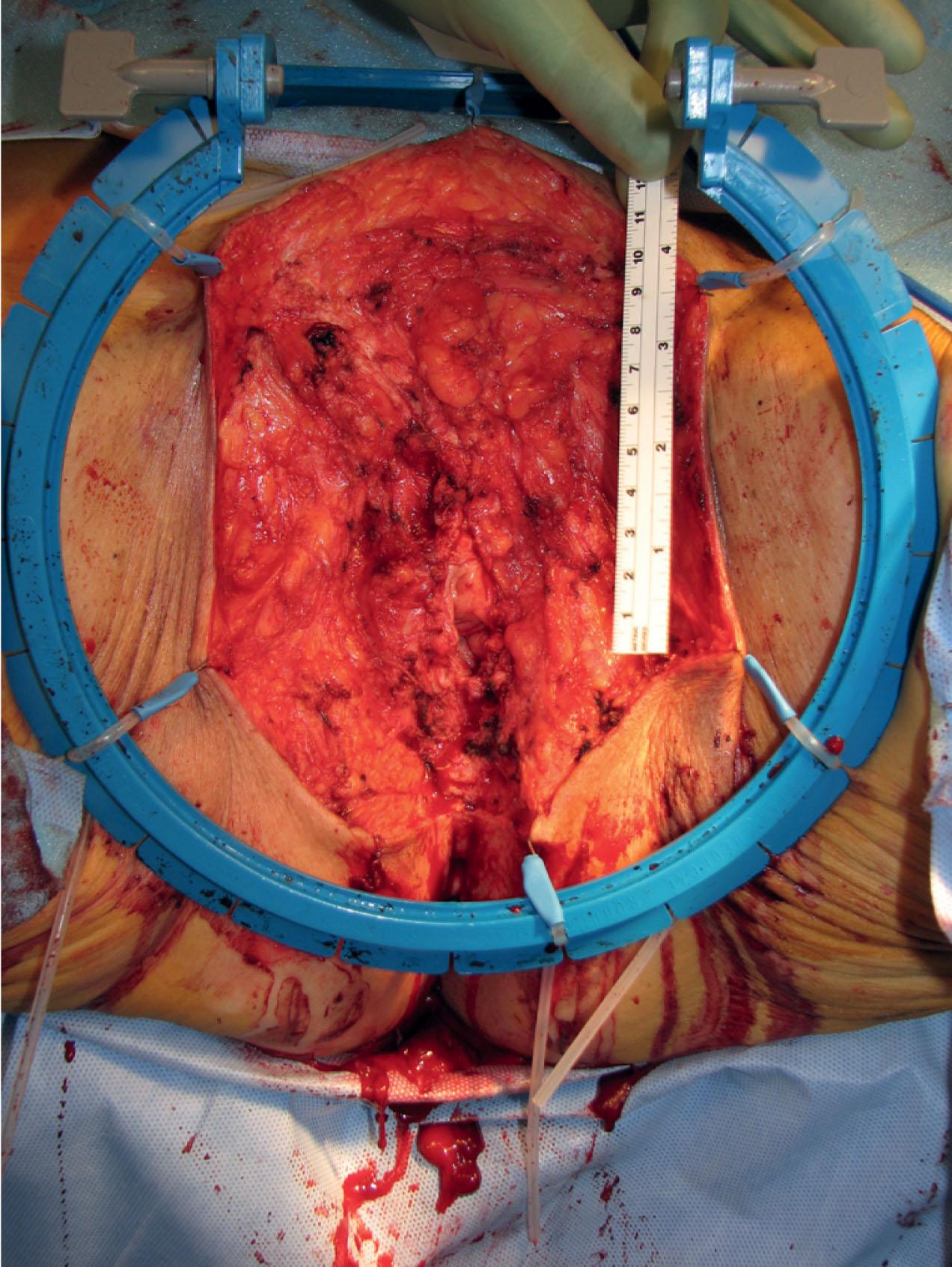 figure 17.3, External perineal skin and soft-tissue loss.