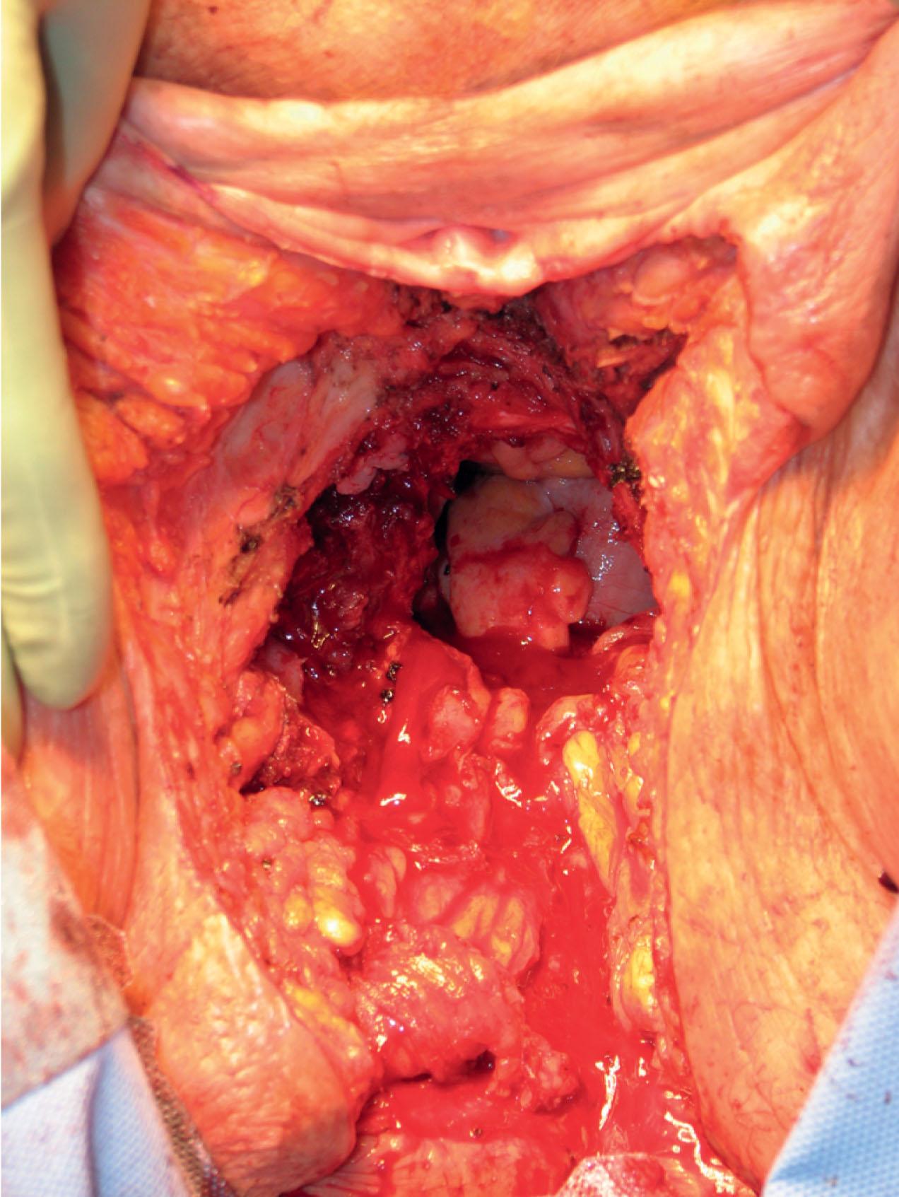 figure 17.4, Complex perineal defect involving external skin, soft tissue, vagina, and pelvic floor.