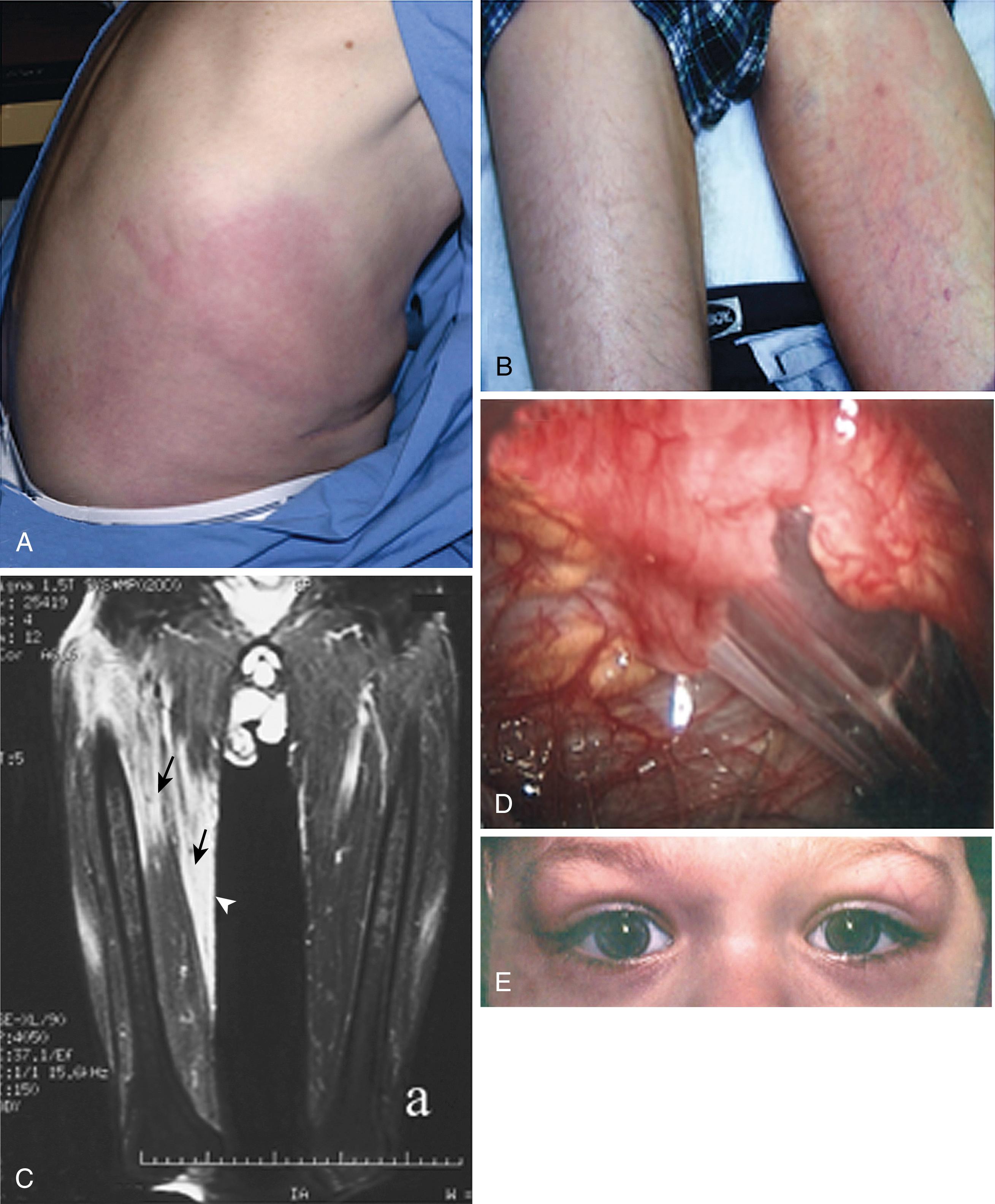 Fig. 39.2, Cutaneous findings associated with tumor necrosis factor (TNF) receptor–associated periodic syndrome (TRAPS) may consist of macular areas of erythema on the torso (A) or on an extremity (B) . C, Sagittal views of the proximal thighs of a TRAPS patient demonstrating edematous changes within muscle compartments ( black arrows ) and extending to the skin ( white arrows ). D, Peritoneal inflammation can lead to adhesions. E, Periorbital edema is commonly observed in patients with TRAPS during a flare.