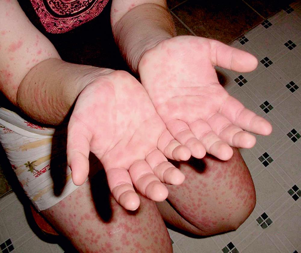 Fig. 39.3, The rash of mevalonate kinase deficiency (MKD)-mild (hyperimmunoglobulinemia D with periodic fever syndrome [HIDS]) may be a diffuse maculopapular eruption often extending to the palms and soles.