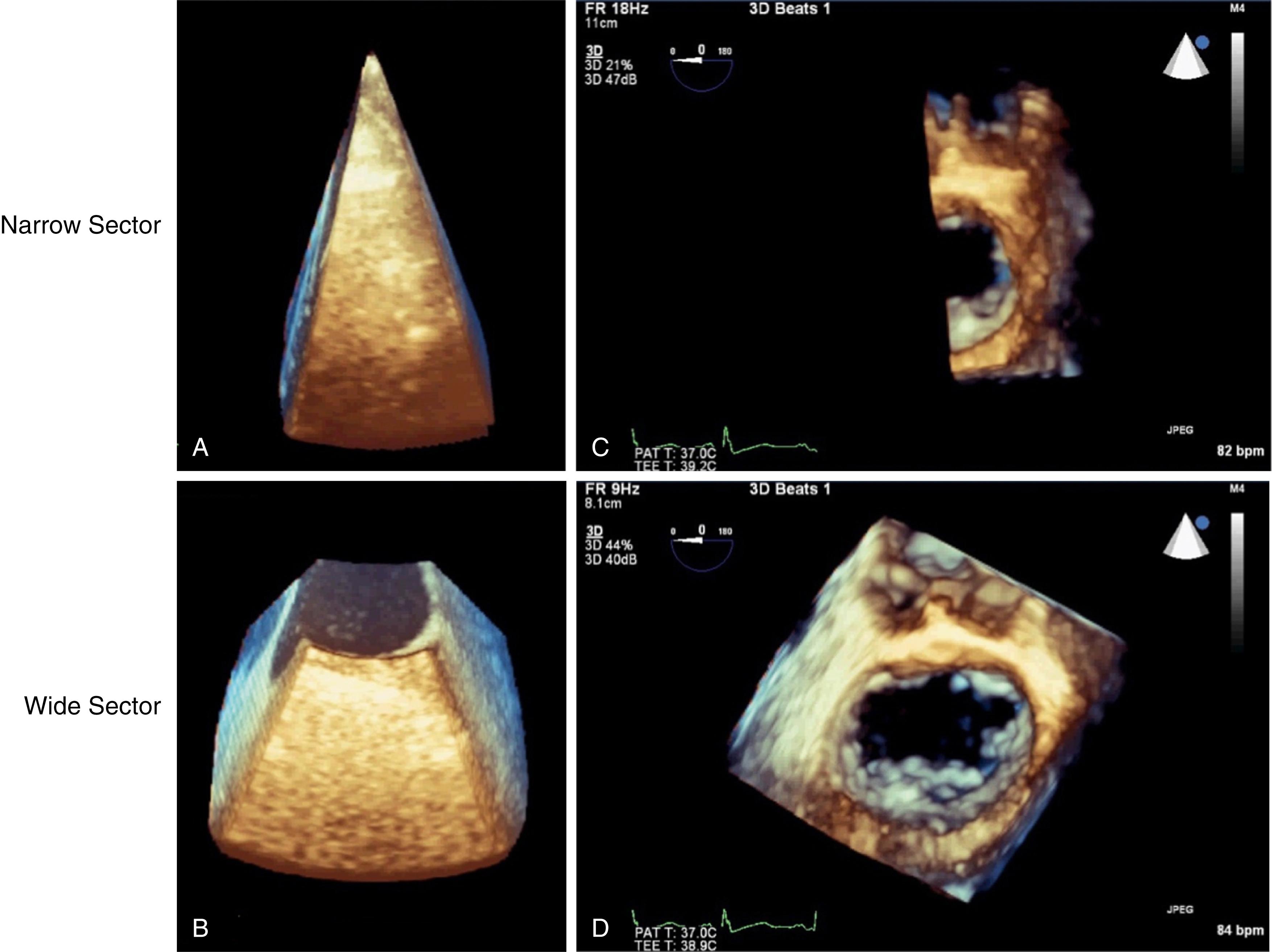 Fig. 37.3, Real-time three-dimensional imaging using narrow sector (top) and wide sector (bottom) modes. (A) Narrow sector imaging displays a narrow, pyramidal volume. (B) Wide sector imaging displays a defined region of interest selected from a larger pyramidal volume. (C) Narrow sector image of the mitral valve after cropping and rotating. Only a portion of the mitral valve structure is visualized. (D) Wide sector image of the mitral valve after cropping and rotating. The entire mitral valve structure is visualized, but at the expense of decreased spatial and temporal resolution.