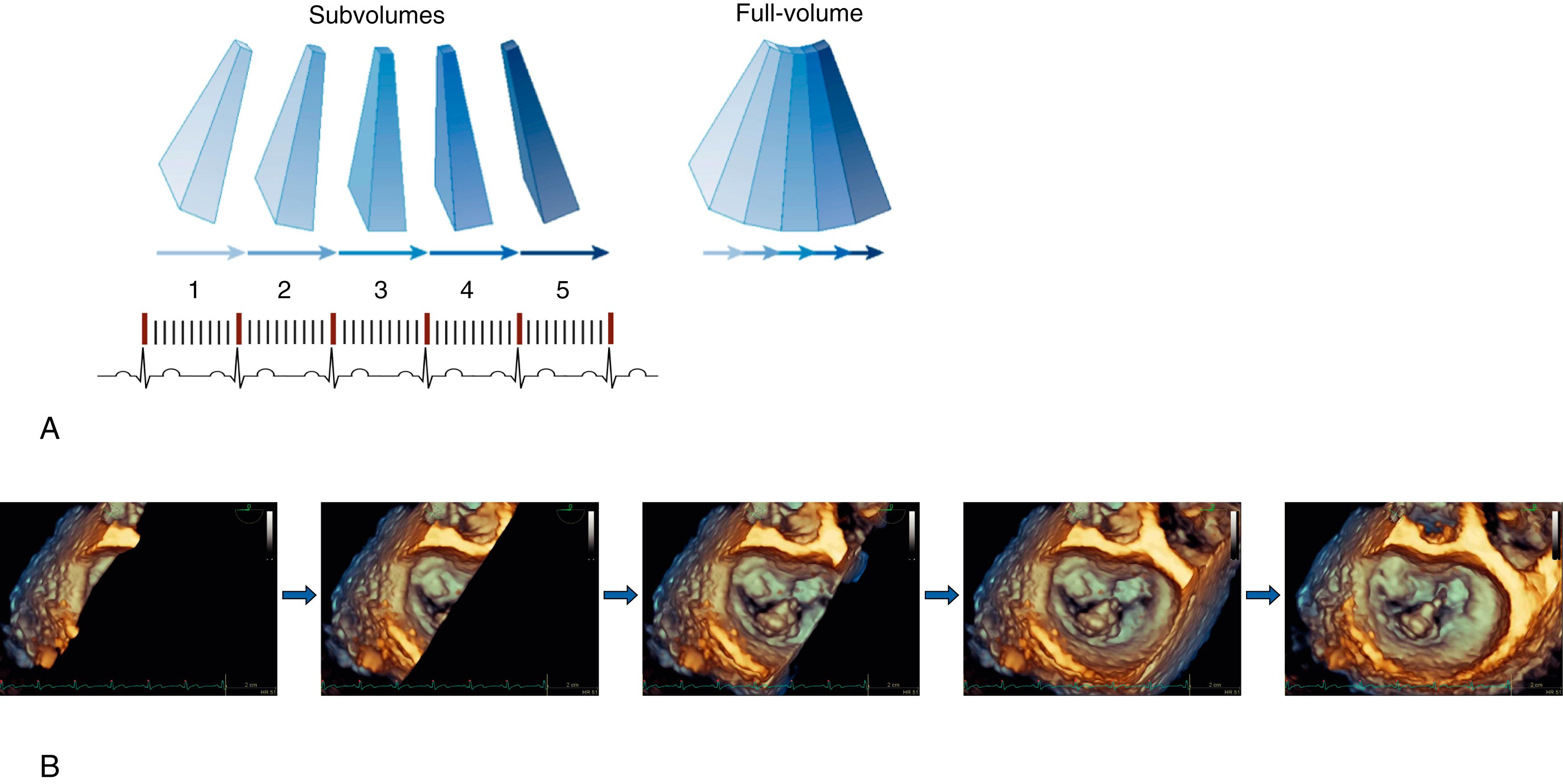 Fig. 37.4, (A) Schematic of multibeat gated full-volume image acquisition. Subvolume acquisition is gated to the R-wave of the electrocardiogram. In this example, subvolume acquisition occurs over five consecutive heartbeats. The individual subvolumes are then synchronized and “stitched” together to create a larger full-volume three-dimensional image. (B) Creation of the three-dimensional (3D) full-volume image from narrow subvolumes.