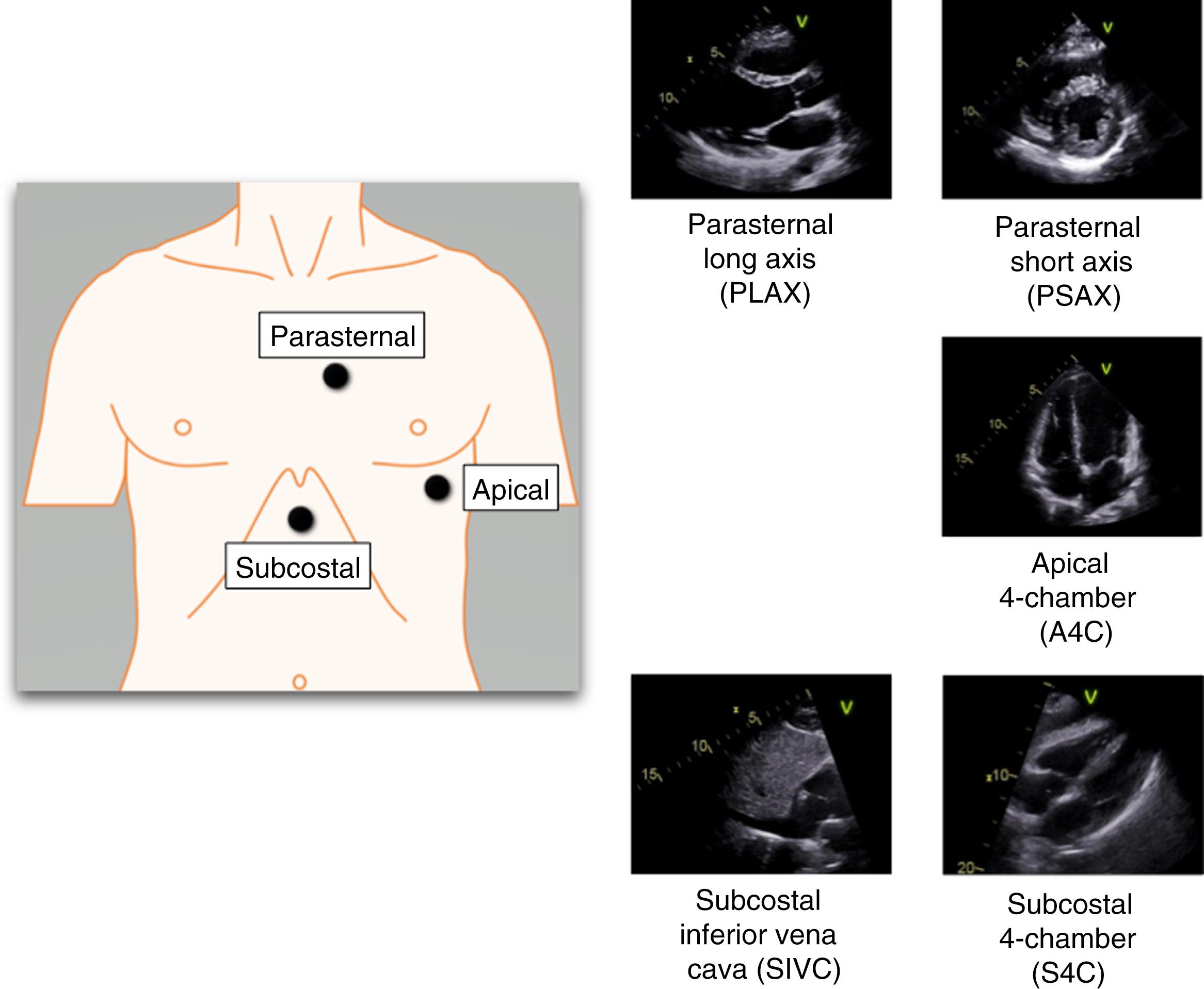 Fig. 37.7, Views included in the focused cardiac ultrasound (FoCUS) examination: parasternal long axis (PLAX) , parasternal short axis (PSAX) , apical 4-chamber (A4C) , subcostal 4-chamber (S4C) , and subcostal inferior vena cava (SIVC) . The parasternal window is between the third through fifth intercostal space to the left of the sternum. The apical window is near the point of maximal impulse along the mid-axillary line, often near the fifth intercostal space. The subcostal window is just below the xiphoid, along the midline or slightly to the patient’s right.