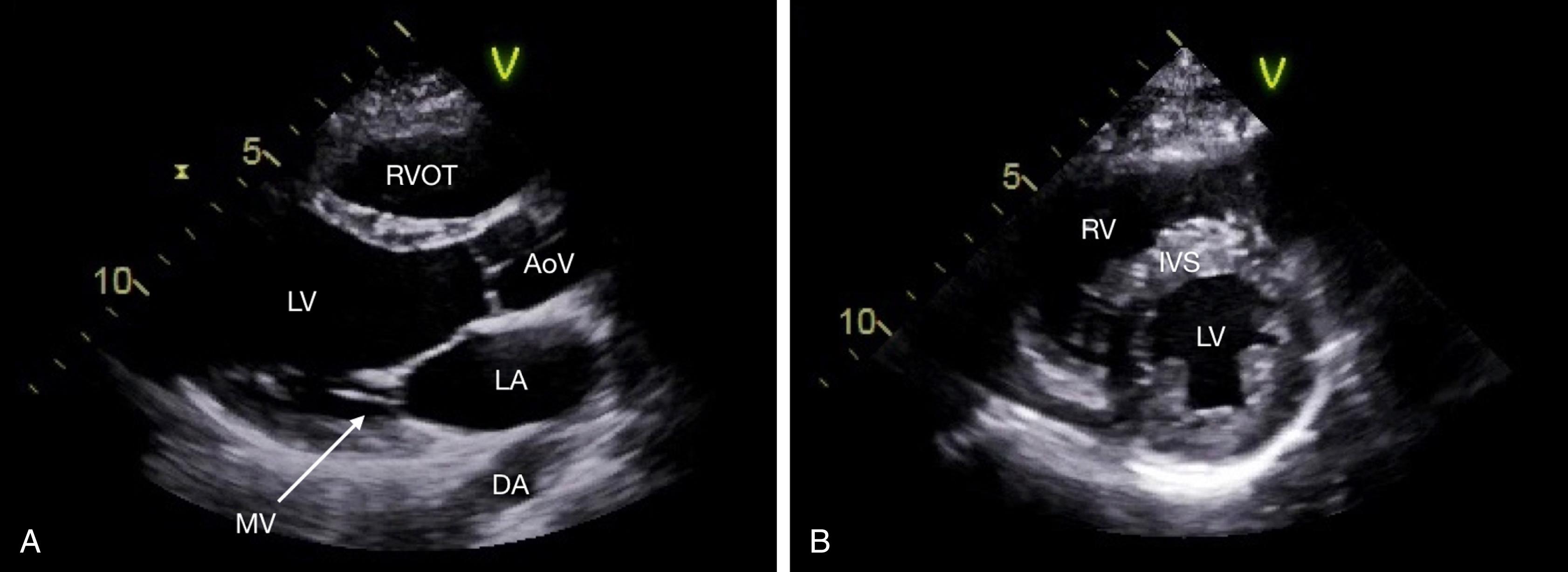 Fig. 37.8, Transthoracic parasternal views included in focused cardiac ultrasound.