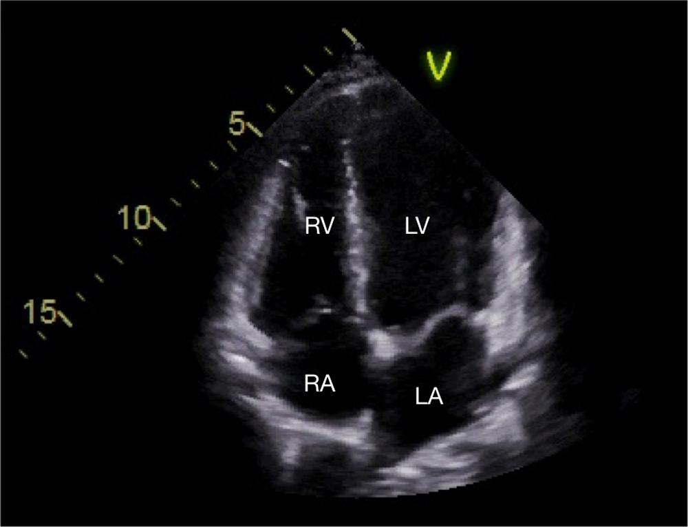 Fig. 37.9, Transthoracic apical four-chamber view.