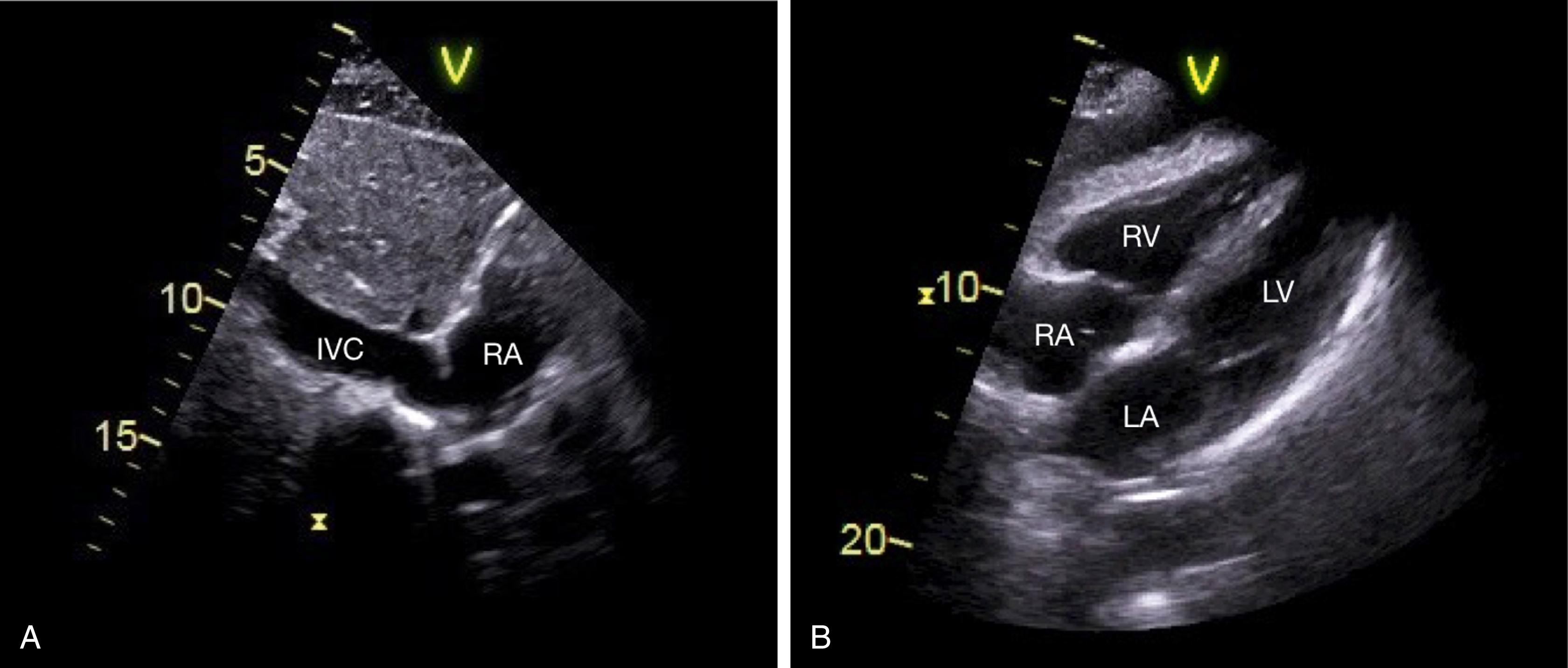 Fig. 37.10, Transthoracic subcostal views included in focused cardiac ultrasound.