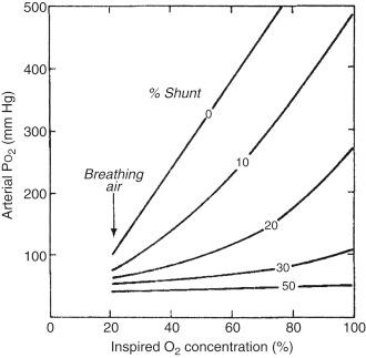 Fig. 159.4, The isoshunt diagram shows the effect of changing the inspired oxygen concentration (Fi o 2 ) on arterial oxygenation (Pa o 2 ) in the presence of varying amounts of pure shunt. Isoshunt lines hold for hemoglobin of 10 to 14 g/dL and arterial partial pressure of carbon dioxide (Pa co 2 ) of 25 to 40 mm Hg.