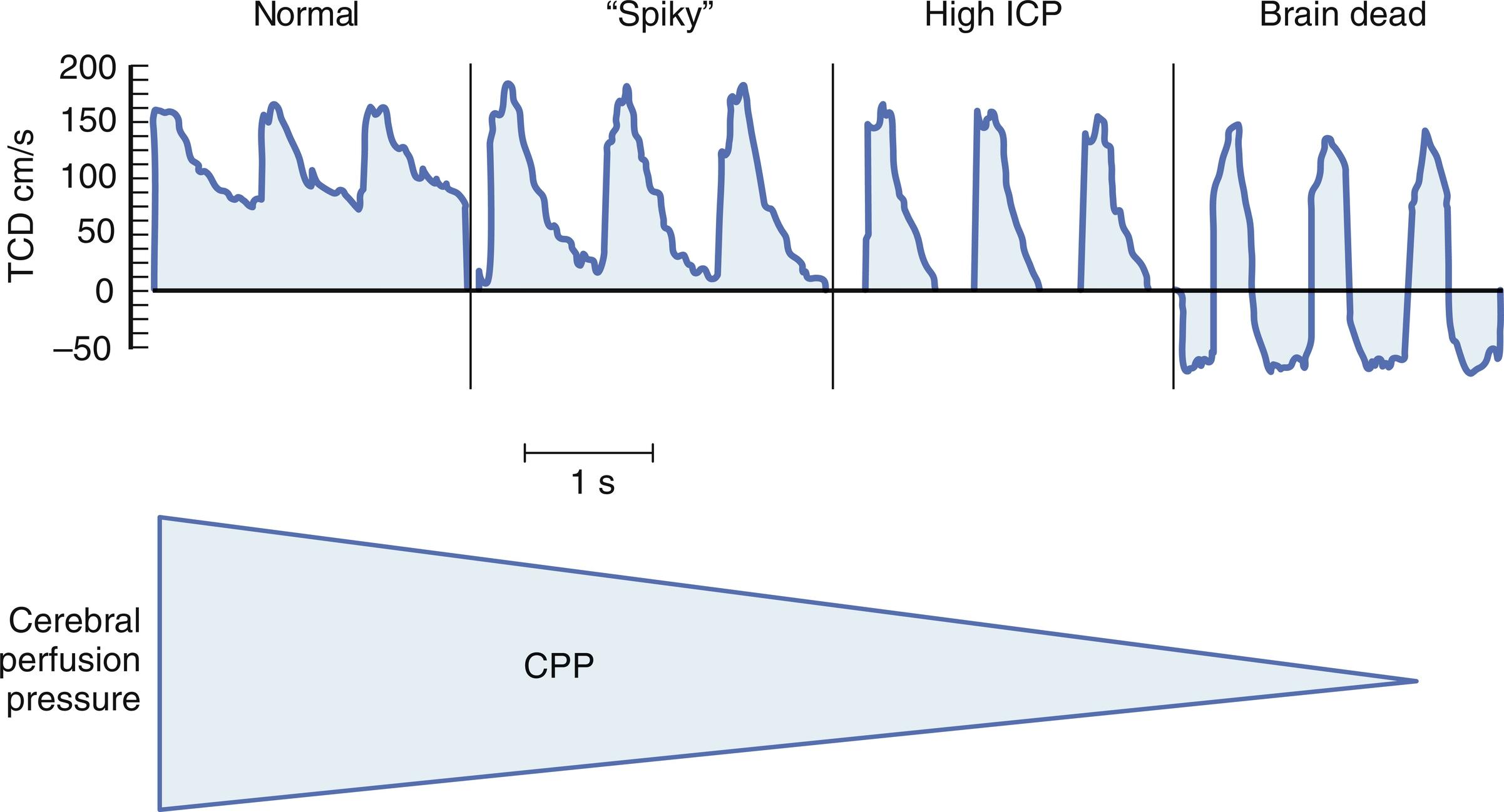 Fig. 24.3, Progression of transcranial Doppler (TCD) waveforms after head injury from intact cerebral blood flow (CBF) and normal appearing TCD waveform to intracranial hypertension sufficient to induce intracerebral circulatory arrest. Schematic of decreasing cerebral perfusion pressure (CPP) indicated in the lower panel. ICP , intracranial pressure.