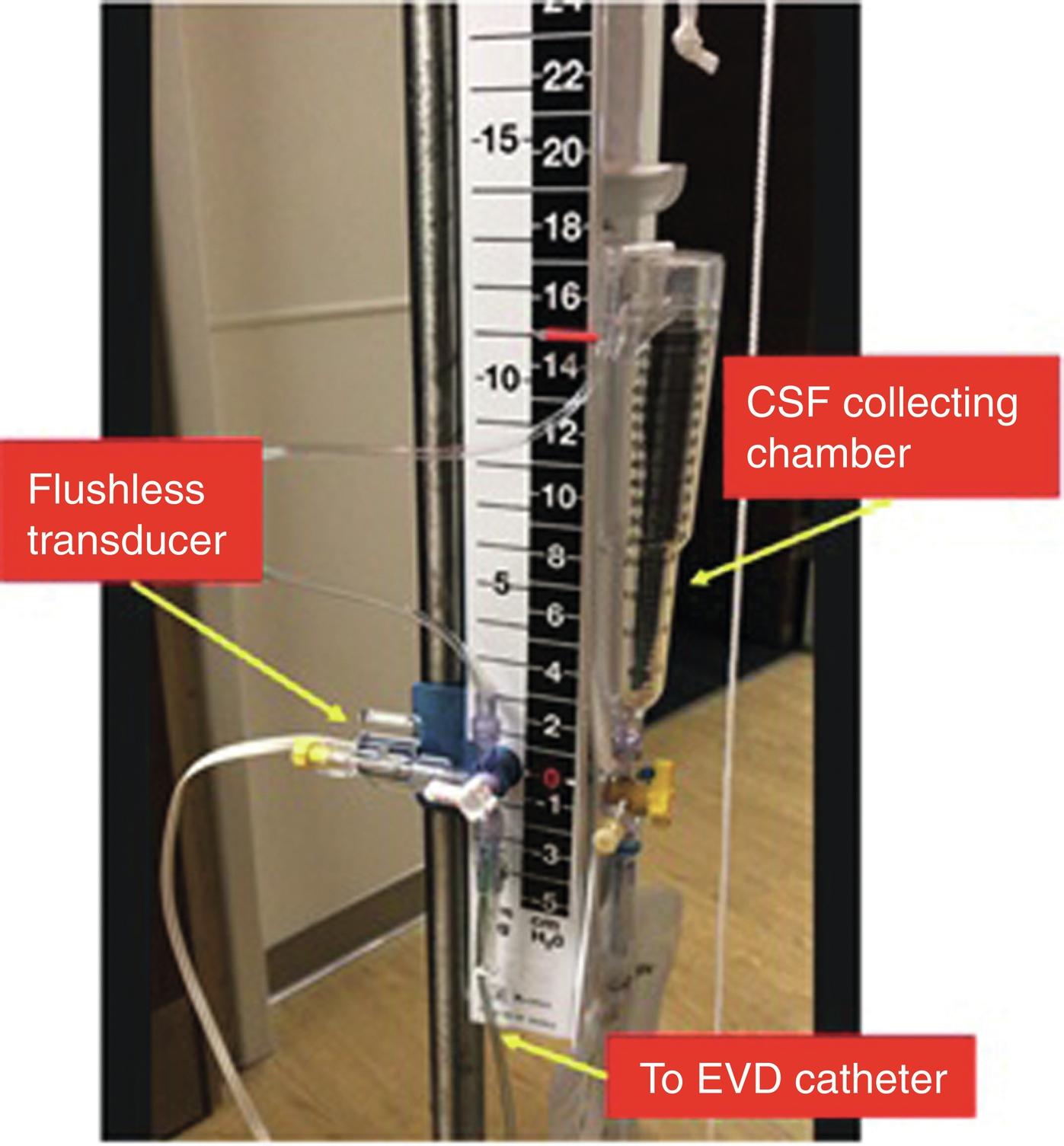 Fig. 24.5, Standard intracranial pressure (ICP) transducer composed of (1) a flushless transducer next to a three-way stopcock thats allows intermittent or continuous ICP monitoring and CSF drainage, and (2) a collecting chamber to accurately quantify CSF drained.