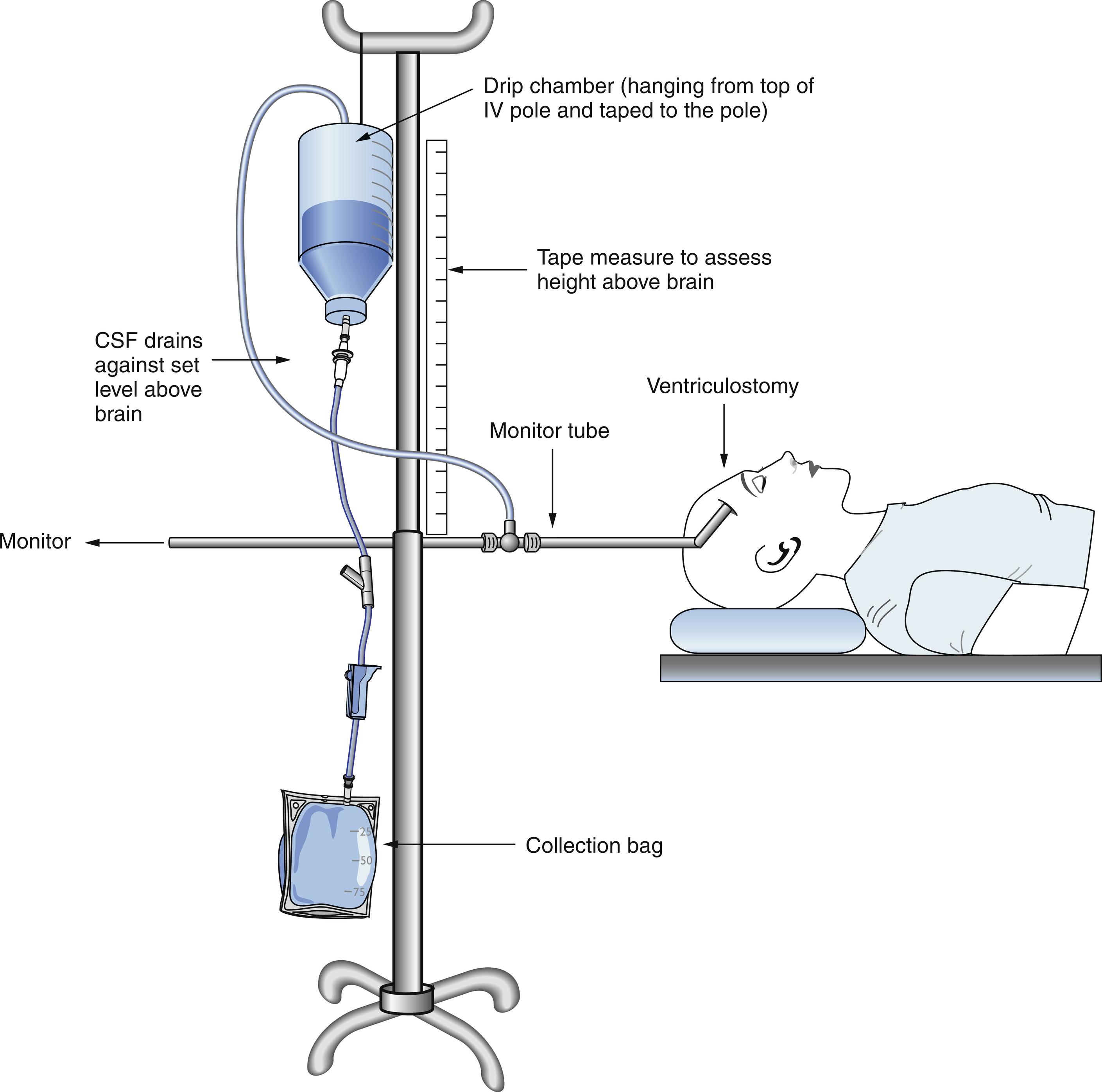 Fig. 24.6, External ventricular drainage system.