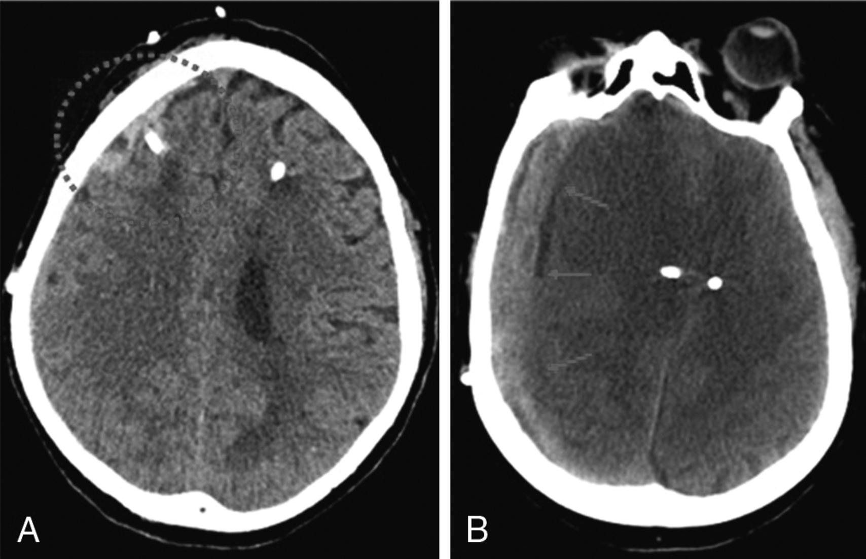 Fig. 24.7, Development of subdural hematoma (SDH) after external ventricular drain (EVD) placement in a patient taking oral anticoagulation. (A) Initial head CT after EVD placement demonstrates a small SDH. (B) Follow-up head CT at 6 hours after EVD placement with significant expansion requiring decompressive surgery.