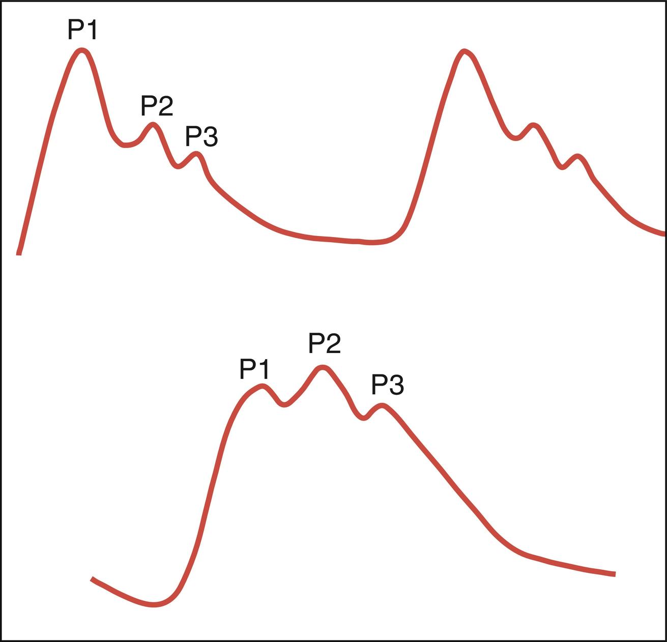 Fig. 24.8, Intracranial pressure (ICP) waveform. Upper tracing: Components of a normal ICP waveform: P1, percussion wave; P2, tidal wave; P3, dicrotic wave. Lower tracing: Typical noncompliant ICP waveform seen in intracranial hypertension. As ICP increases, a distinctive elevation of the P2 wave above P1 occurs.