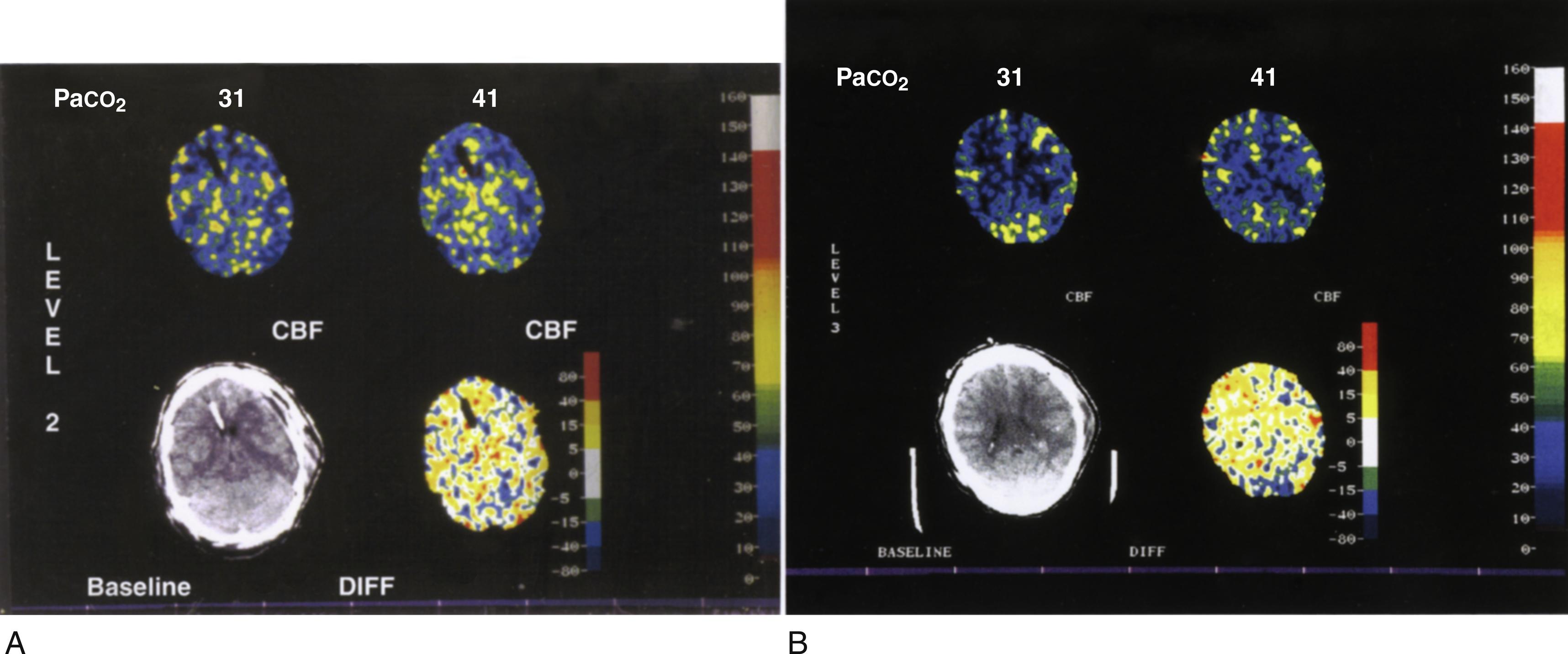 Fig. 24.10, Effects of hyperventilation on cerebral blood flow (CBF) . Two examples of disparate effects of hyperventilation on CBF. Both figures are stable xenon CBFs in head trauma patients with and without hyperventilation. CBF scale is indicated on the right in mL/100 g/min and is indicated above each study. CT images are indicated in the lower figures and CBF maps in the upper figures. (A) PaCO 2 was decreased from 39 to 29 mmHg. The baseline scan (right) shows hyperemia and the hyperventilated scan (left) shows CBFs of approximately 30 mL/100 g per minute, which are probably acceptable flows. (B) PaCO 2 was decreased from 46 to 30 mmHg. The baseline CBF ( right ) had only marginally acceptable CBF. The effect of hyperventilation ( left ) was to produce widespread areas of CBF less than 20 mL/100 g per minute, which are probably unacceptable flows.