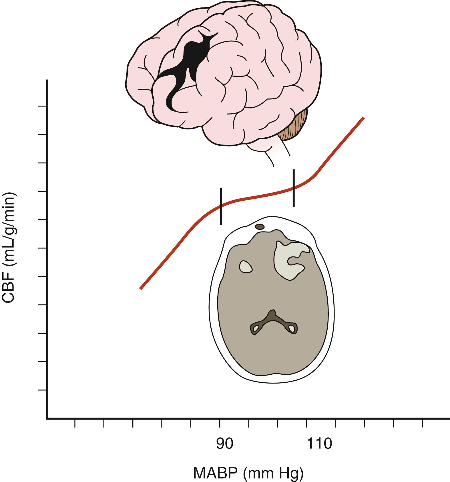 FIGURE 122.2, Aberrant cerebral pressure autoregulation after severe traumatic brain injury.