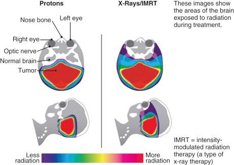 FIGURE 11.1, Rendering of the difference between photon (x-ray) and proton beam therapies for posterior fossa radiation. As radiation passes from posterior to anterior, the entry dose of radiation to healthy tissues of the posterior skull is similar. However, the exit radiation dose is markedly different: the protons lose their energy at a calculated depth, resulting in no radiation to sensitive tissues beyond the tumor (eyes, pituitary, and so on).