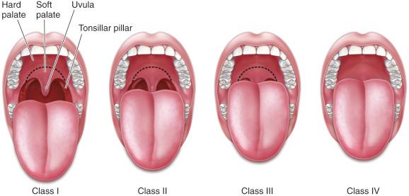 Fig. 24.1, Mallampati Classification. Class I: Full visibility of tonsils, uvula, and soft palate. Class II: Visibility of hard and soft palate, upper portion of tonsils and uvula. Class III: Soft and hard palate and base of the uvula are visible. Class IV: Only hard palate is visible.