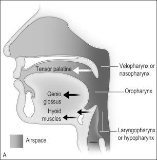 FIG. 14.1, (A) The action of the most important dilator muscles of the upper airway. The tensor palatine, genioglossus, and hyoid muscles enlarge the nasopharynx, oropharynx, and the laryngopharynx, respectively. (B) Collapse of the nasopharynx at the palatal level, the oropharynx at the glottic level, and the laryngopharynx at the epiglottic level.