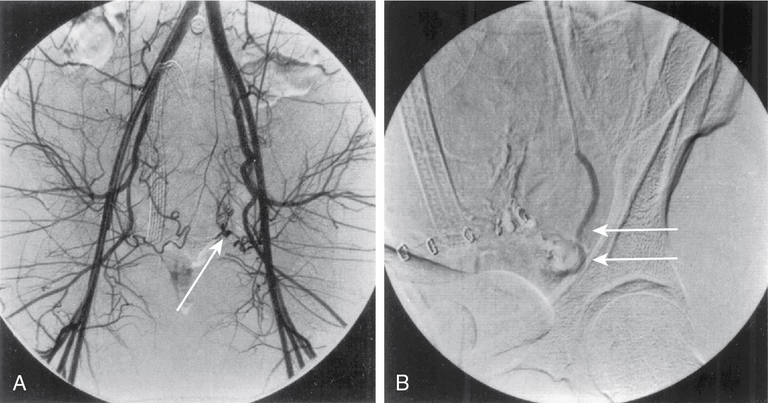 Fig. 25.4, A, Anteroposterior digital subtraction pelvic angiogram in 37-year-old woman with persistent pelvic bleeding after surgical myomectomy for uterine leiomyomas demonstrates contrast pooling ( arrows ) from branches of left uterine artery, consistent with active hemorrhage. B, Postembolization left uterine arteriogram shows occluded left uterine artery (long arrows) with no evidence of active bleeding.