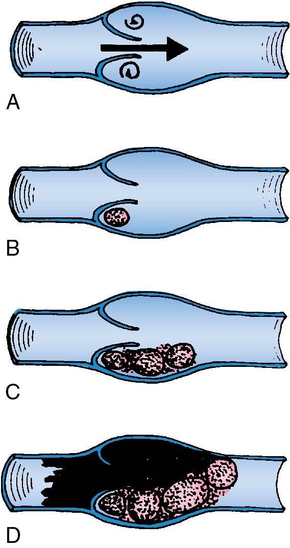 Fig. 25.5, Stages in development of thrombus in valve pocket of deep veins of leg. A, Stasis in valve pocket results in thrombin generation. B, Platelet aggregation and fibrin formation. C, Propagation of platelet- fibrin nidus. D, Blockage of venous flow with resultant retrograde extension.