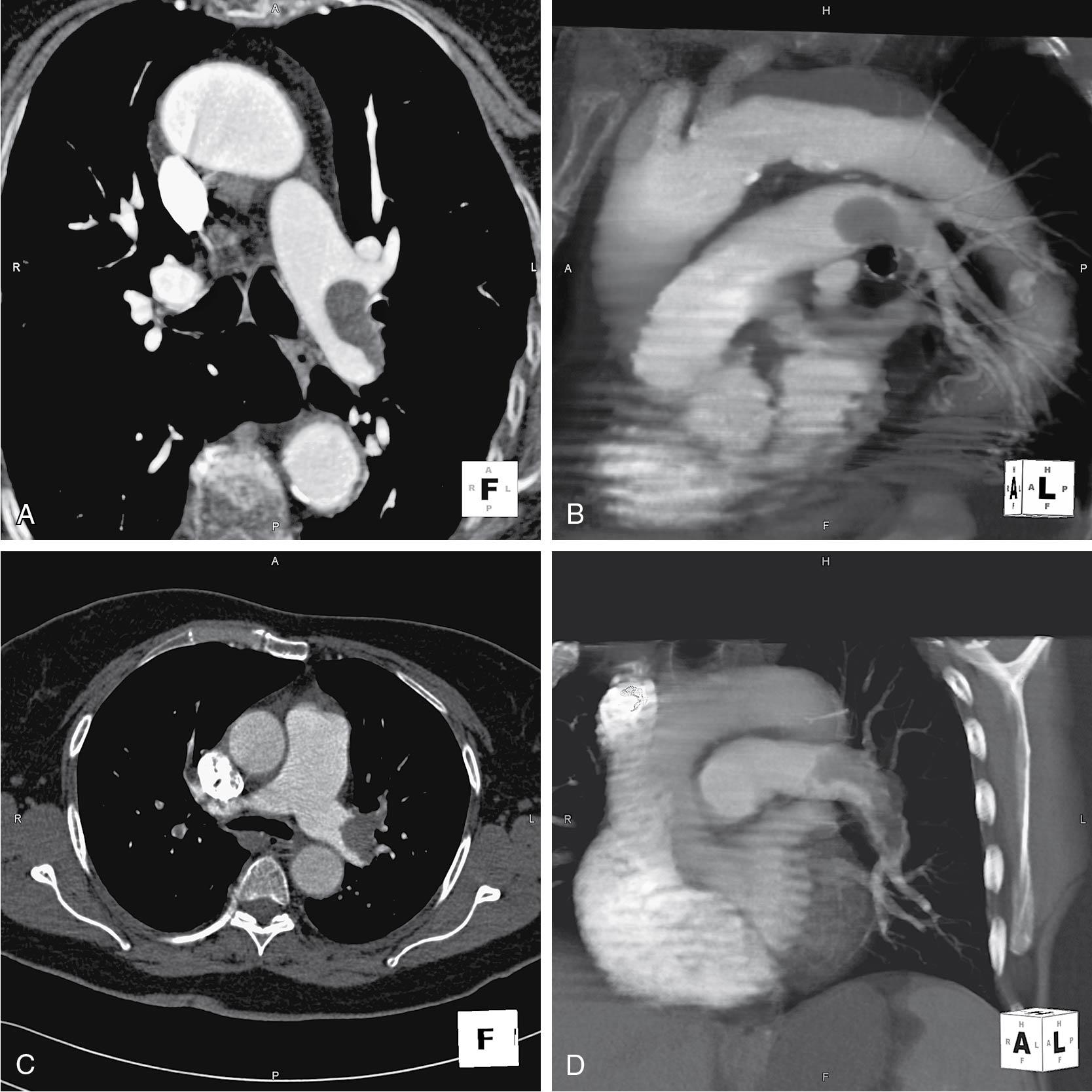 Fig. 25.6, A to D, Helical CT of pulmonary embolism. The letters on the cube help orient the viewer as the three-dimensional image is rotated. A, Anterior; F, foot; H, head; L, left.