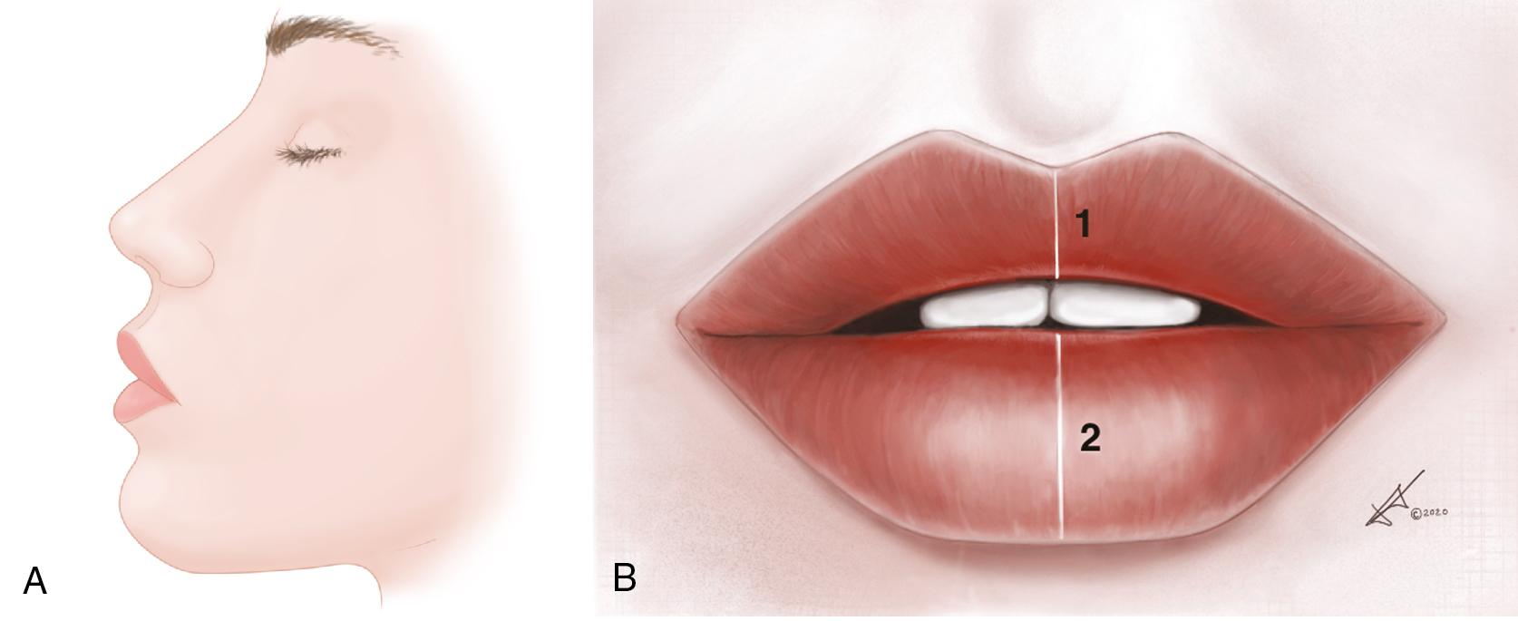 Fig. 37.1, (A) The ideal lateral appearance of the lips. Note the provocative concavity flanking the upper and lower vermilion and the 2-mm protrusion of the upper lip in relation to the lower lip. (B) The idealized anteroposterior (AP) appearance of the lips.