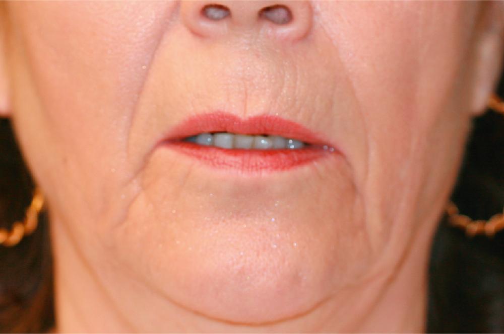 Fig. 37.2, The aging perioral region. Note the elongation of the upper lip, philtral absence, vermilion inversion, ptosis of the commissures and lower lip. The upper incisors are fully eclipsed, whereas the lower incisors are visible. Radial rhytides are apparent.