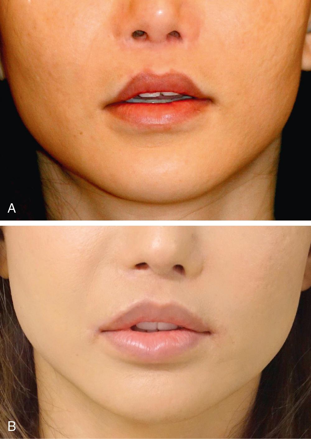 Fig. 37.4, (A) This transgender patient displayed a negative labium apostrophos manifesting as lateral upper vermilion inversion. (B) A bilateral medialized external corner lip lift (MECLL) was performed not only to improve the shape of the upper lip but also to shorten the lateral aspects of the cutaneous upper lip.