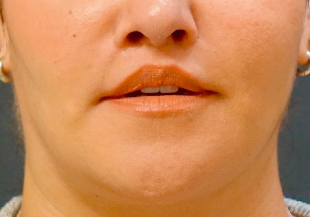 Fig. 37.5, The sequelae from a “modified upper lip lift” by another surgeon. Basically, this was a “skin only” lip lift, marketed as an improved procedure to the unsuspecting. Note the exacerbated apostrophe lip with accompanying upper vermilion slope exaggeration, as well as right nasoalar inferior dystopia and accompanying tangential crease.