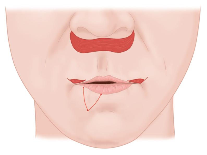 Fig. 37.7, A customized hypothetical lip-reshaping surgery (LRS) plan would include an orbicularis oris suspension (OOS) lip lift and a traditional corner lip lift. In addition, a unilateral right lower lip V-Y plasty to specifically evert the relatively inverted lower vermilion would be indicated.