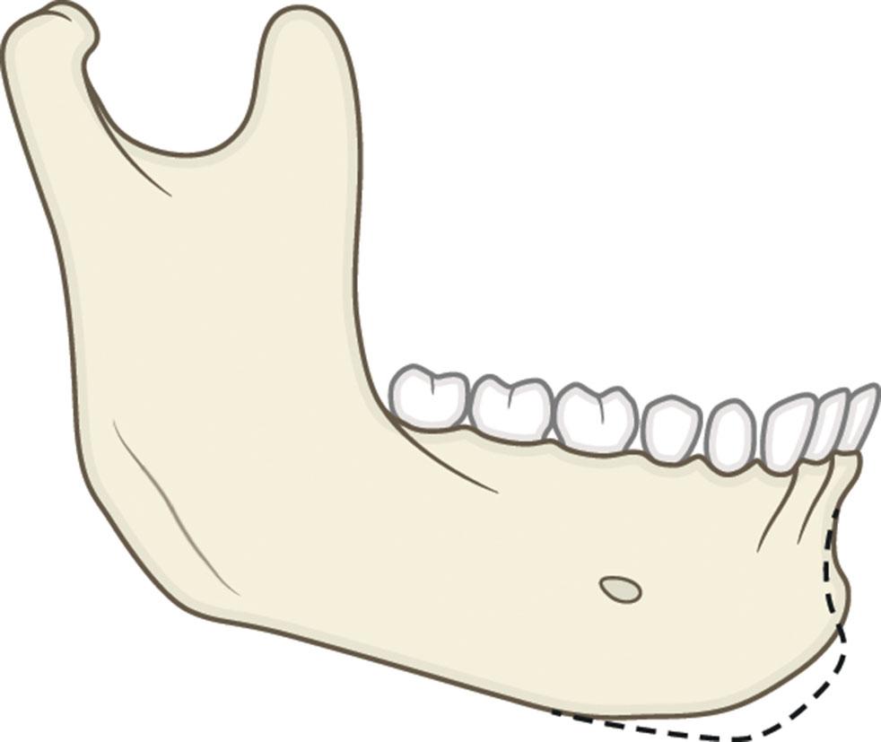 Figure 9.13.11, Horizontal excess and vertical deficiency. The dashed line represents the normal chin outline.