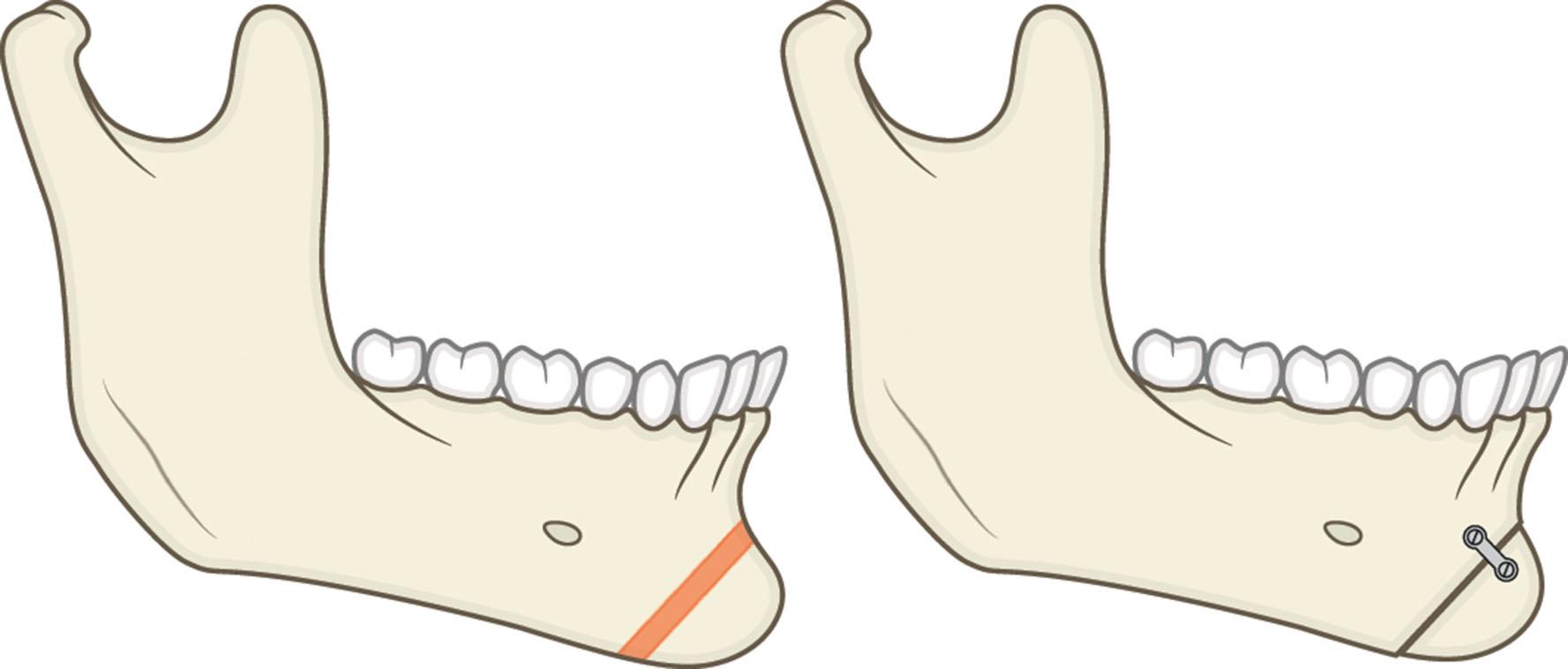 Figure 9.13.13, Isolated horizontal excess treatment.