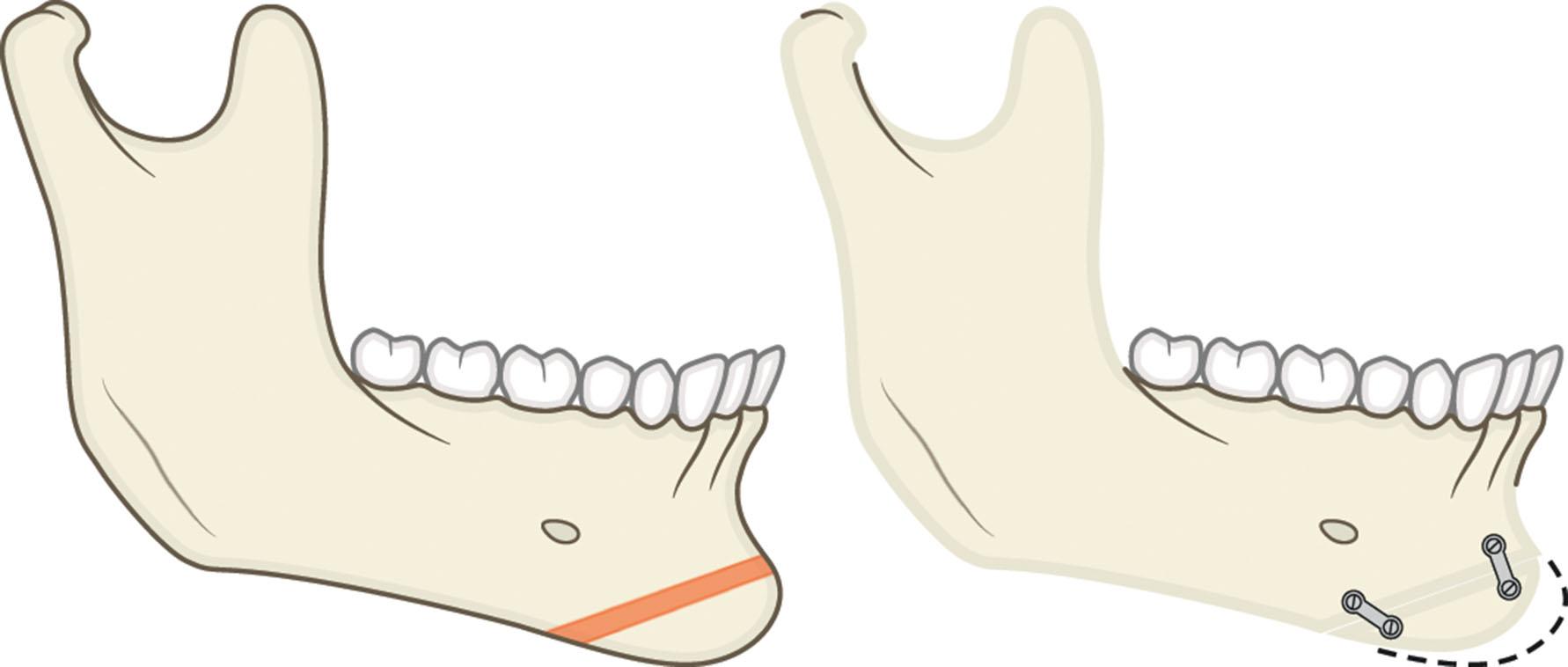 Figure 9.13.14, Isolated vertical excess treatment.