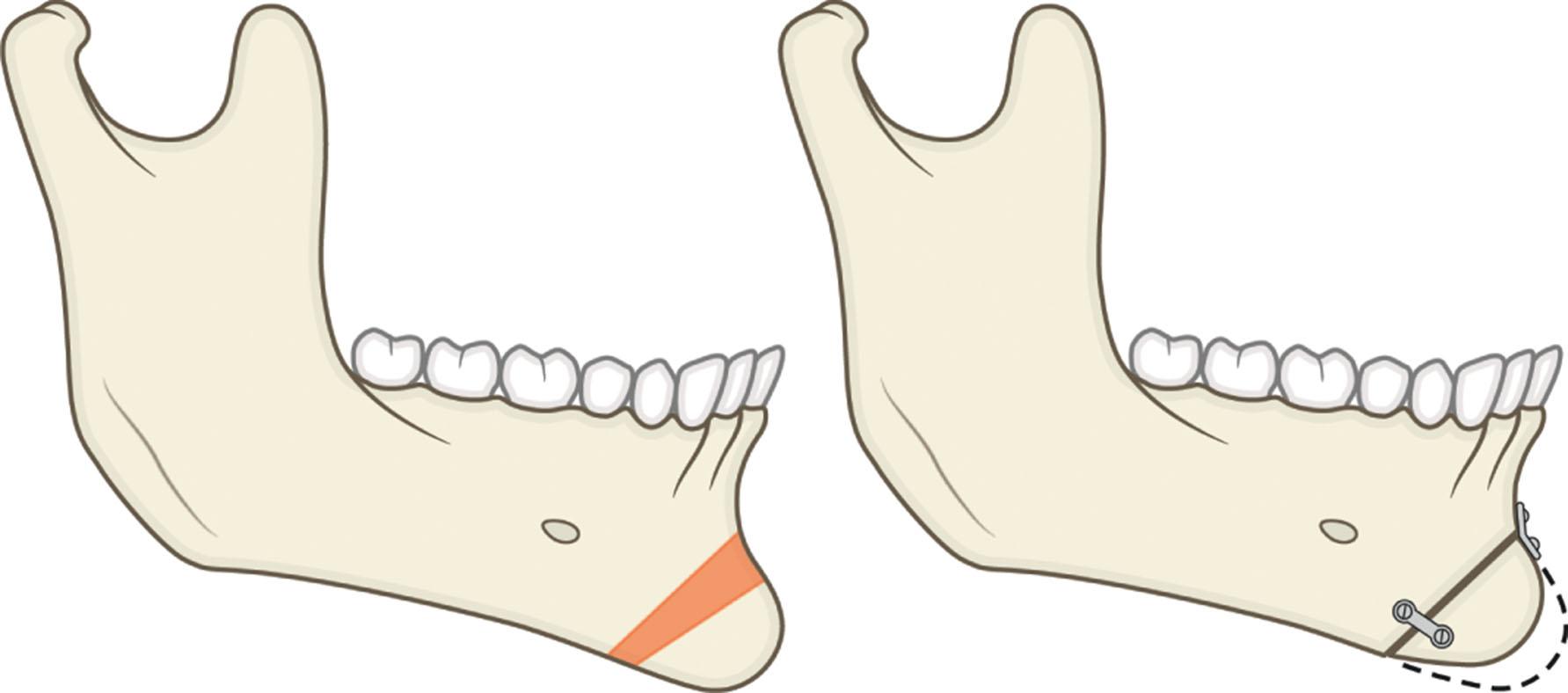 Figure 9.13.16, Change of the inclination of resected bone.