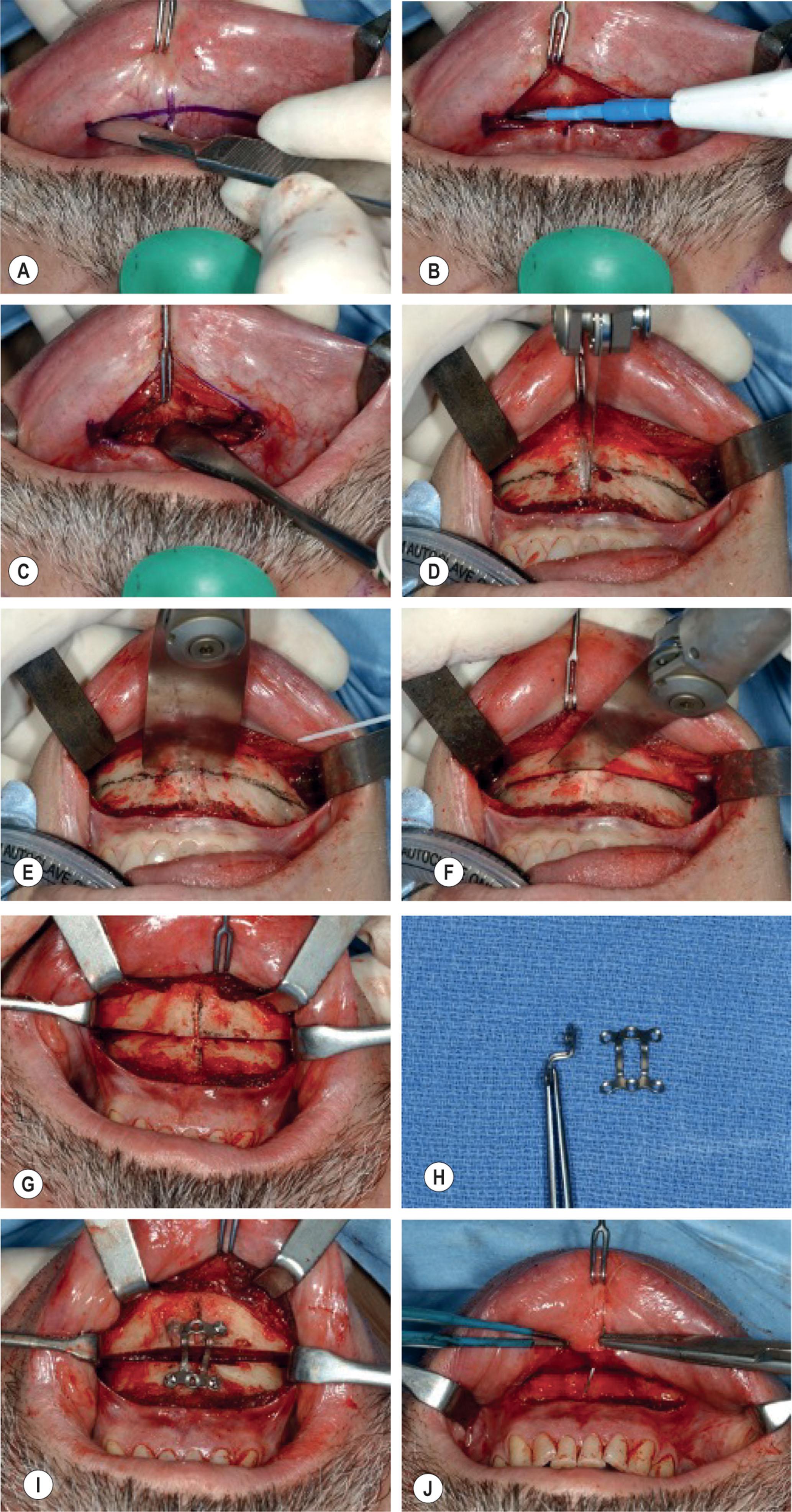 Figure 9.13.26, (A–C) Ostectomy; (D–J) Sliding osseous genioplasty.