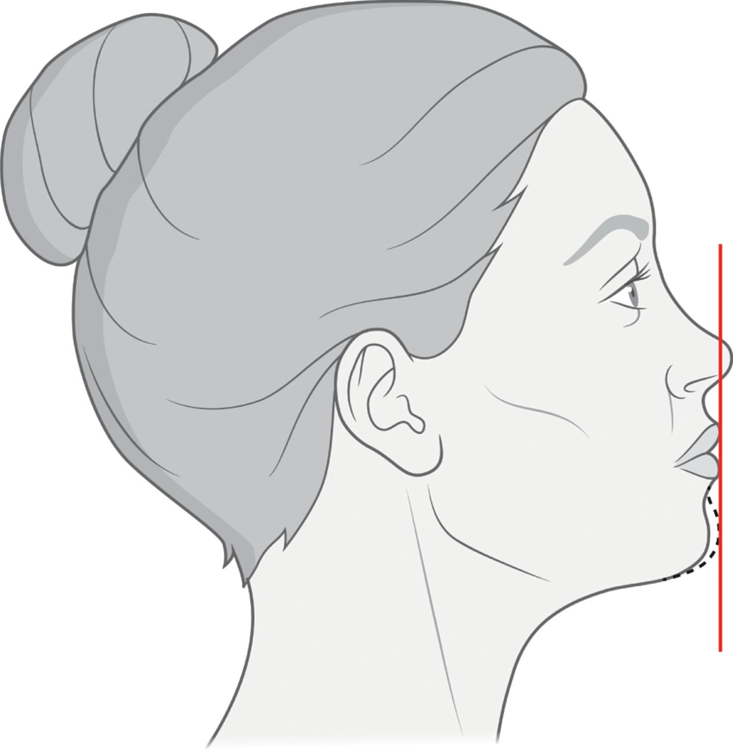 Figure 9.13.3, Riedel's line (red). The dashed line shows the ideal position of the chin.