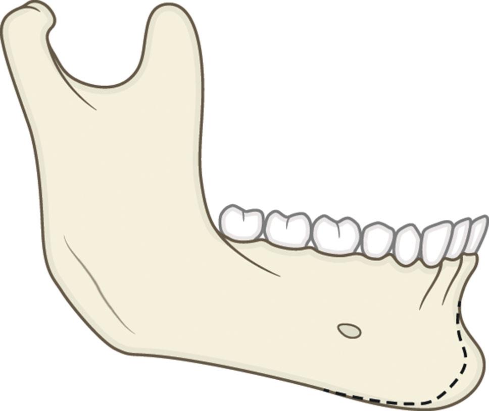 Figure 9.13.4, Horizontal microgenia. The dashed line represents the normal chin outline.