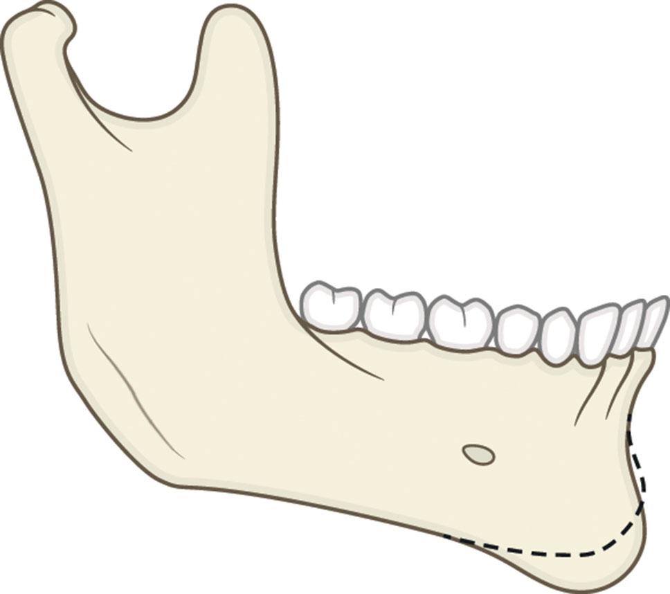 Figure 9.13.5, Vertical macrogenia. The dashed line represents the normal chin outline.