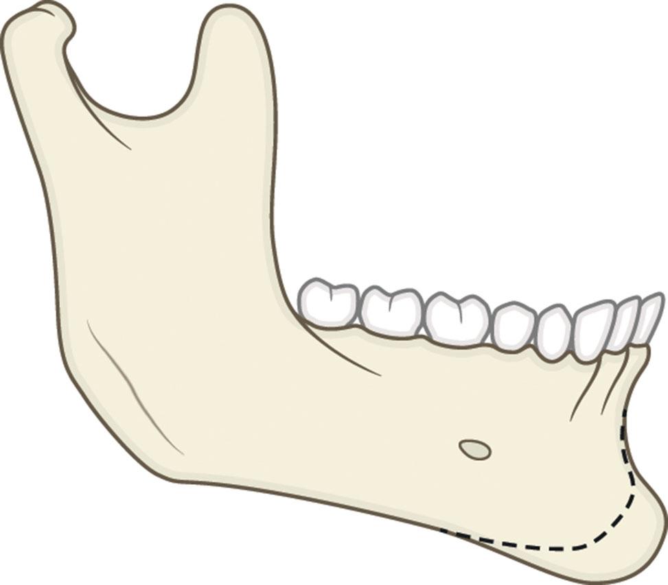 Figure 9.13.6, Combination horizontal and vertical macrogenia. The dashed line represents the normal chin outline.