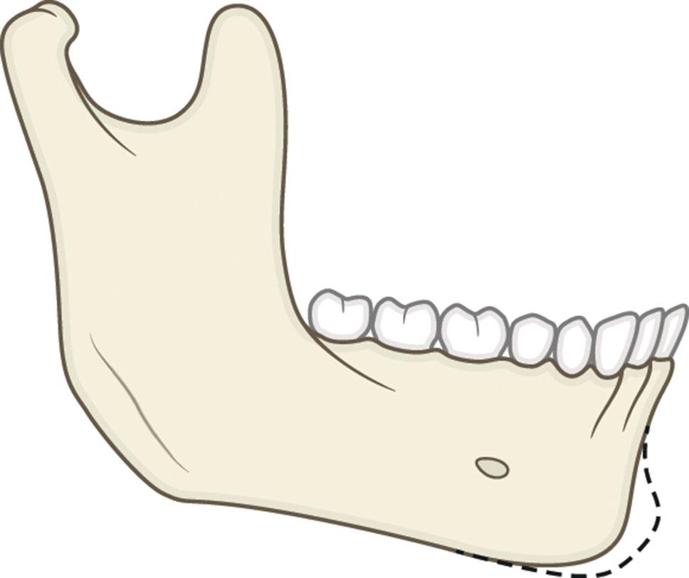 Figure 9.13.7, Horizontal microgenia. The dashed line represents the normal chin outline.