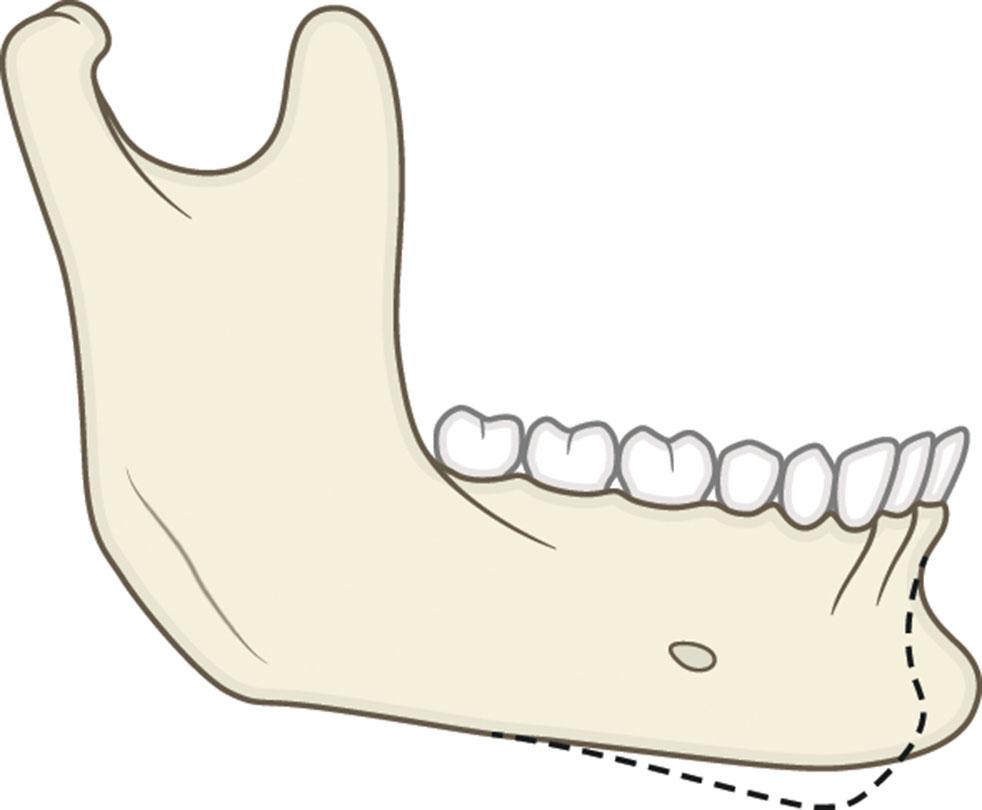 Figure 9.13.8, Vertical microgenia. The dashed line represents the normal chin outline.