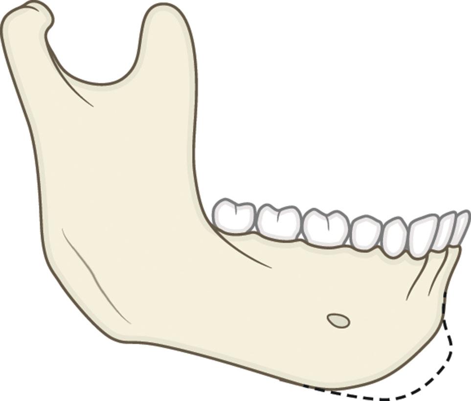 Figure 9.13.9, Combination of horizontal and vertical microgenia. The dashed line represents the normal chin outline.