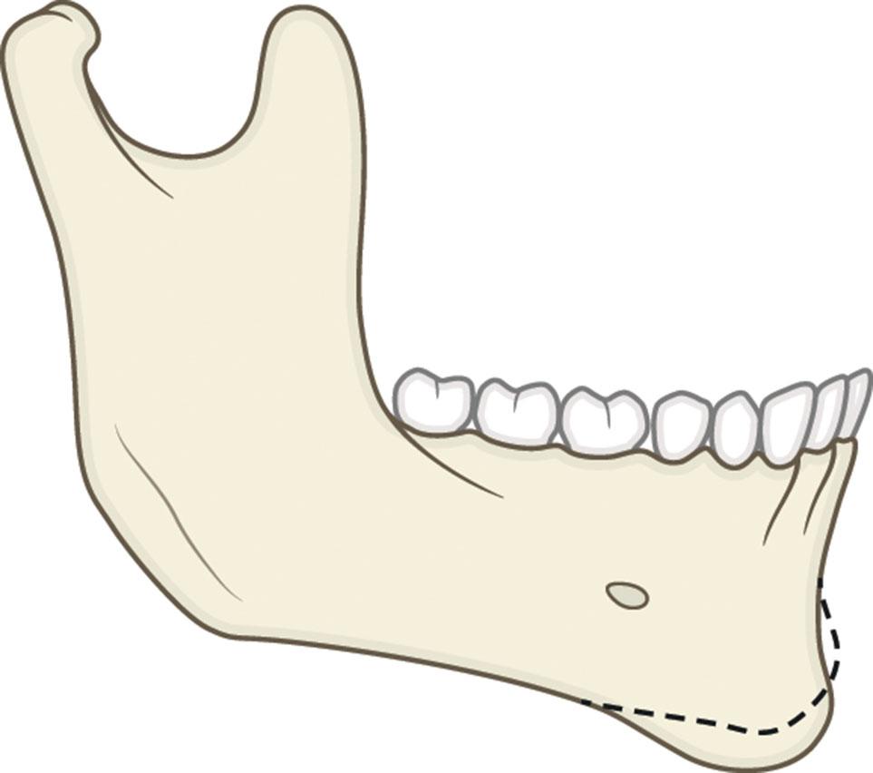 Figure 9.13.10, Vertical excess and horizontal deficiency. The dashed line represents the normal chin outline.